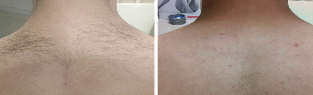 Permanent hair removal with Clarity laser - Practice in Zurich for  aesthetic medicine
